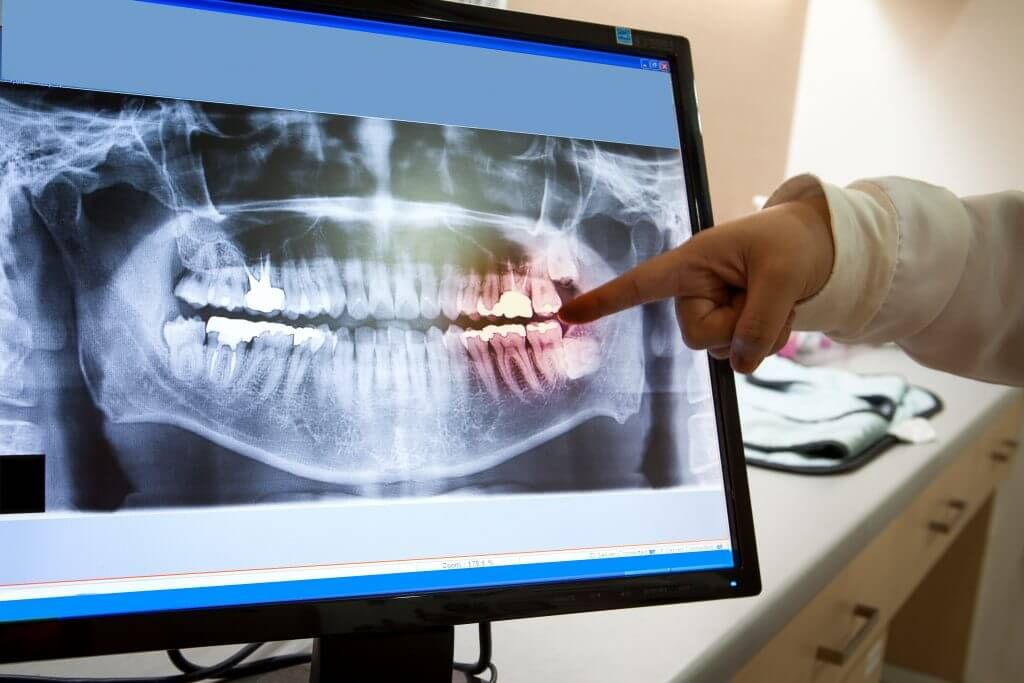 Benefits of Digital X-Rays